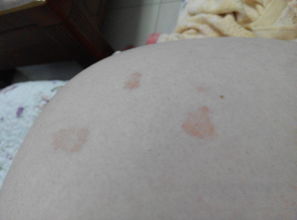 血小板紫癜是一种什么病(血小板减少性紫癜能治好吗)